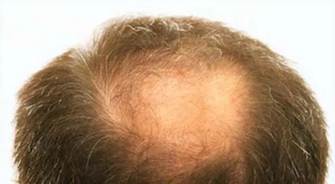 3 Shocking Causes of Hair Loss You Might Not Have Heard Before