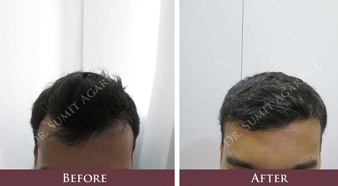 Why India Is The World Leader In Hair Transplant Treatments?