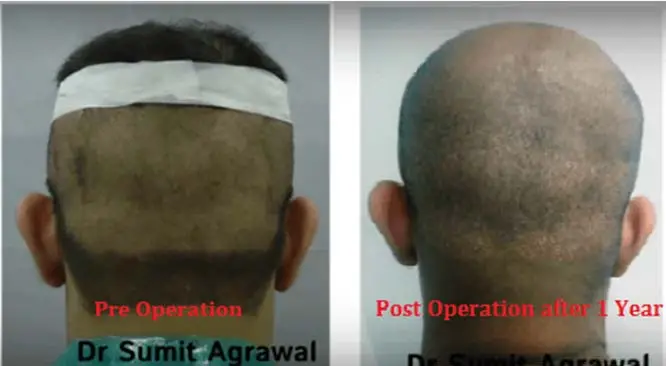 Why Expert Surgeons Suggest FUE Hair Transplant?