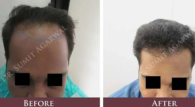 You Must Avoid These 7 Things After Getting Hair Transplant Surgery