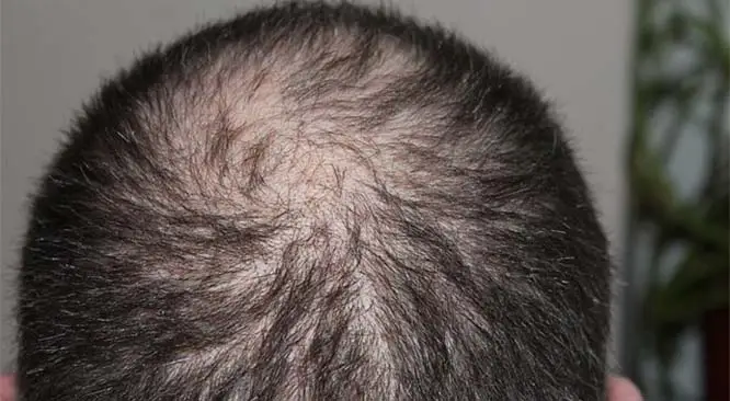 4 Effective Tips Frequently Used By People To Prevent Hair Loss