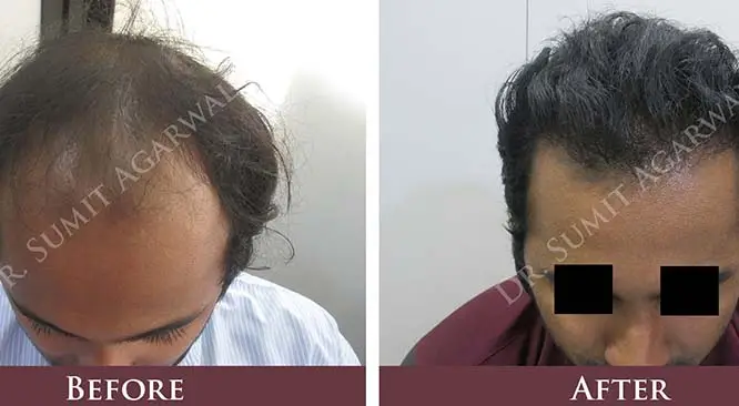 What’s The Ideal Age For Hair Transplant?