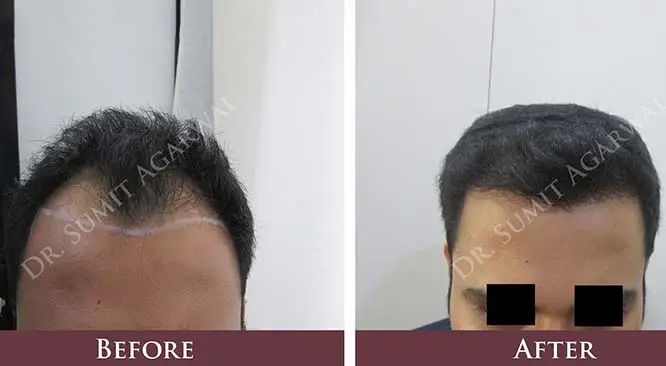 Who Qualifies For Hair Transplant?