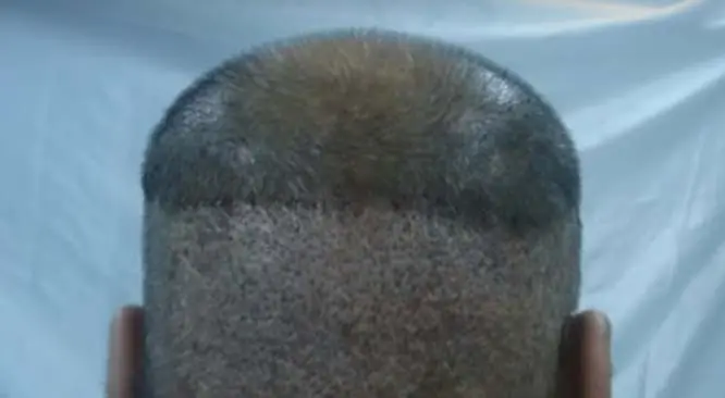 An Overview Of FUE (Follicular Unit Extraction) Hair Transplant
