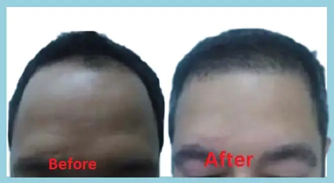 Why Choosing FUE Hair Transplant Technique Is A Smart Decision