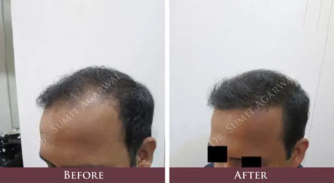 How Skills Of Surgeon & Results Of Hair Transplant Are Interconnected?