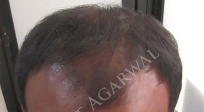 How Men Can Deal With Traction Alopecia?