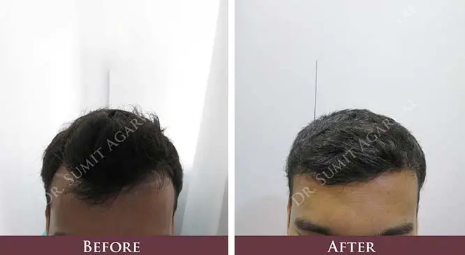 Things You Must Know About Hair Transplant Aftercare