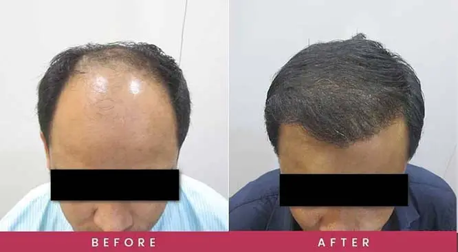 Avoid These 20 Things After Hair Transplant