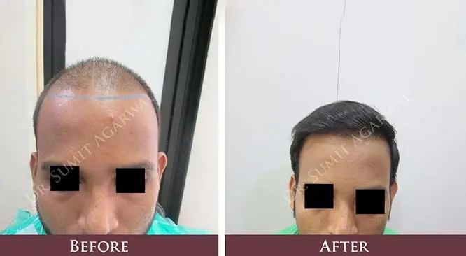 How Painful FUE Hair Transplant Procedure Really Is?