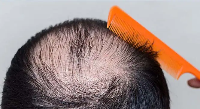 Hair Loss In Early Youth