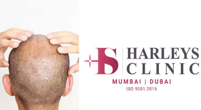 What Should You Know Before Hair Transplantation