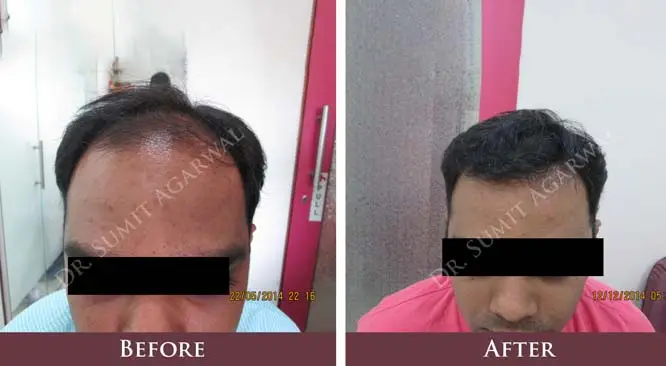 Factors Affecting The Cost of Hair Transplant in India