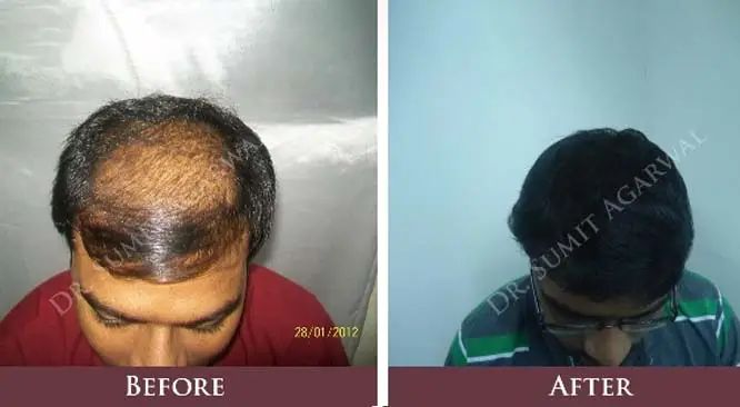 All You Need To Know About Hair Transplant Treatment In Dubai