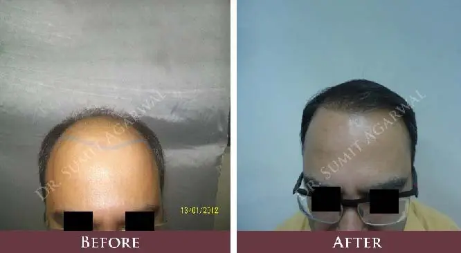 8 Myths About Hair Transplant Debunked
