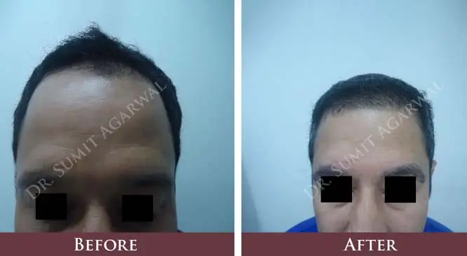 Hair Transplant – How Advance The Treatment Has Become