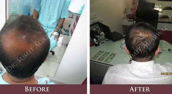 Important Questions About Hair Transplant Surgery