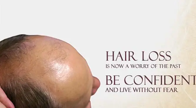 A Glimpse of Hair Transplant In India