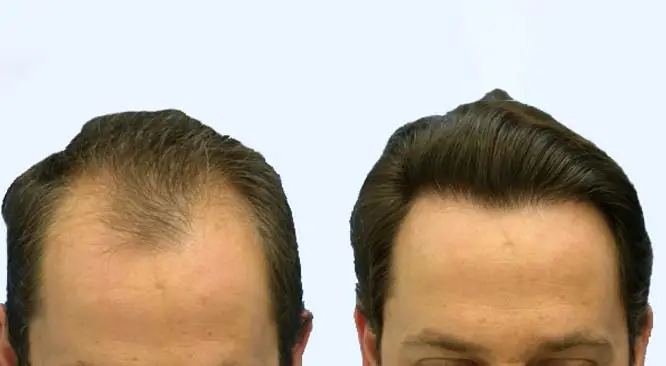 Top 4 Questions To Ask Before Hair Transplant Surgery