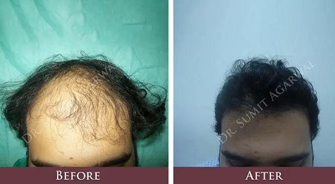 5 Things You Should Know About Hair Transplant In India
