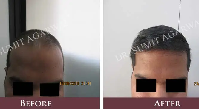 6 Important Questions For Hair Transplant Surgery