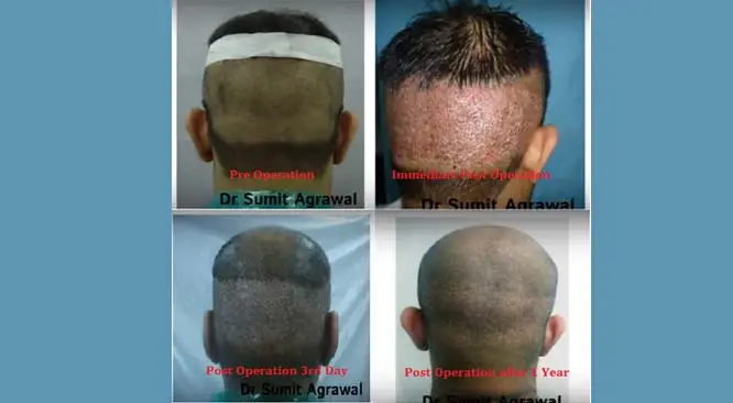 Which Hair Transplant Is Better – FUT Or FUE?