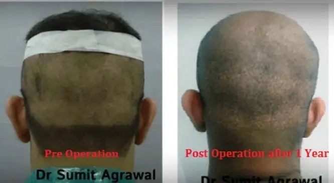 The Hair Loss Problem & Advantages Of Having FUE Hair Transplant