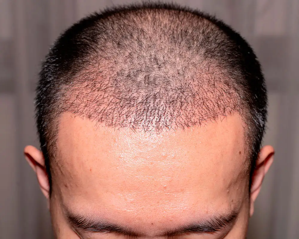 All You Need to Know About Hair Transplantation