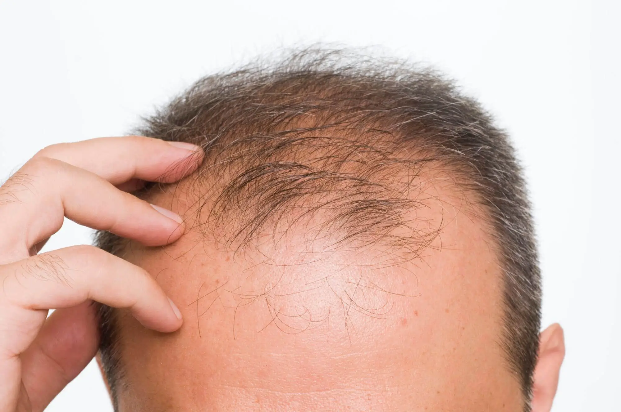 All About Male Pattern Hair Loss