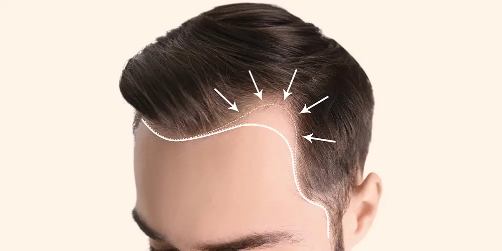 How Hair Transplants Can Overcome Male Pattern Baldness Advantages of Hair Transplant