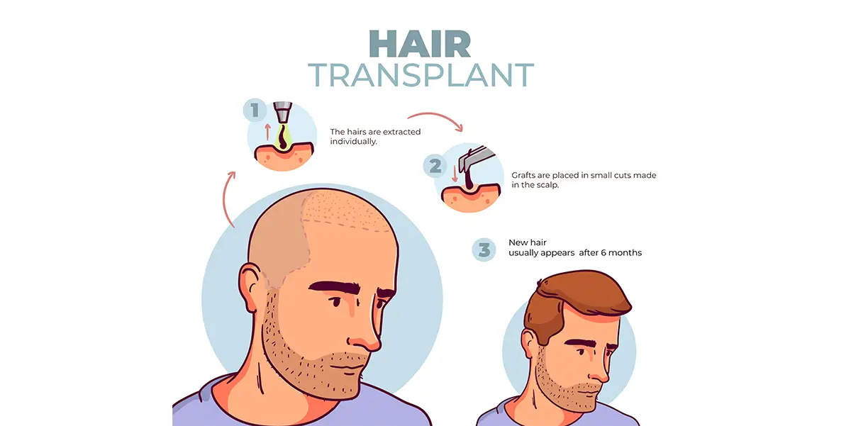 Advantages of Hair Transplant