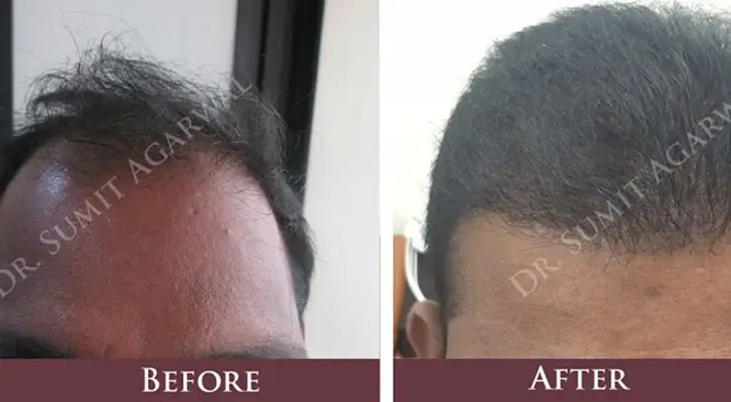 Important Things To Consider Before Hair Transplant