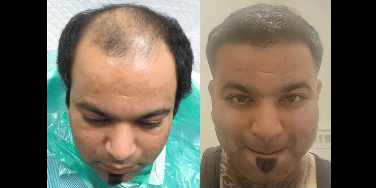 A successful hair transplant in Mumbai for a 34-year-old man with Norwood Grade 5 hair loss