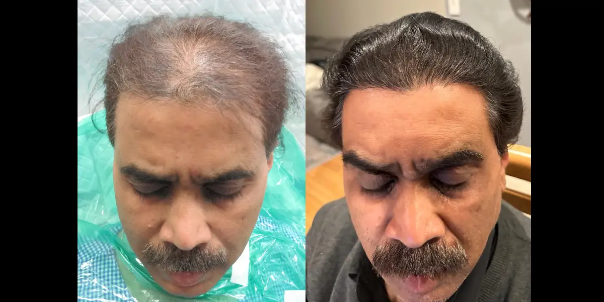 Successful Hair Transplant in Mumbai for a 64-Year-Old Man with Norwood Grade 4 Hair Loss