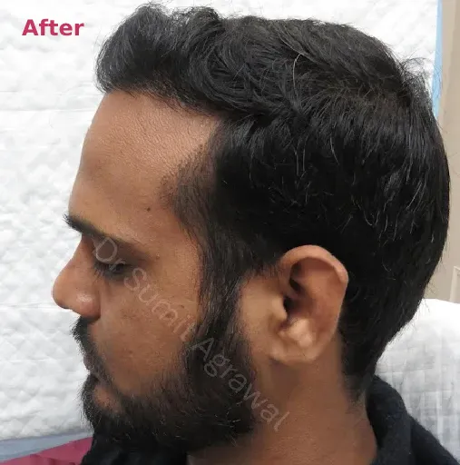 Hair Transplant After 2