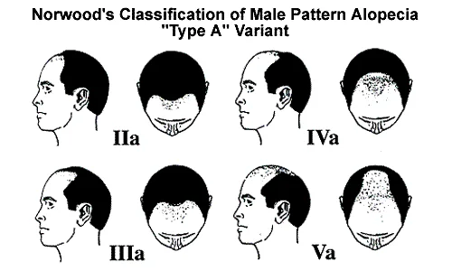 Norwood's Classification of Male Pattern Alopecia Type "A" Variant