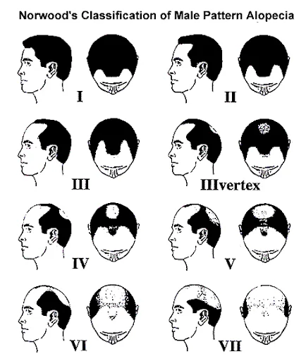 Norwood's Classification of Male Pattern Alopecia