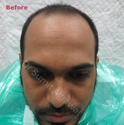 Hair Transplant Before 1