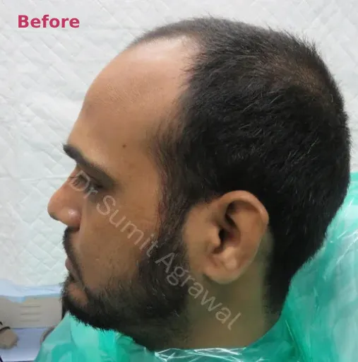 Hair Transplant Before 2