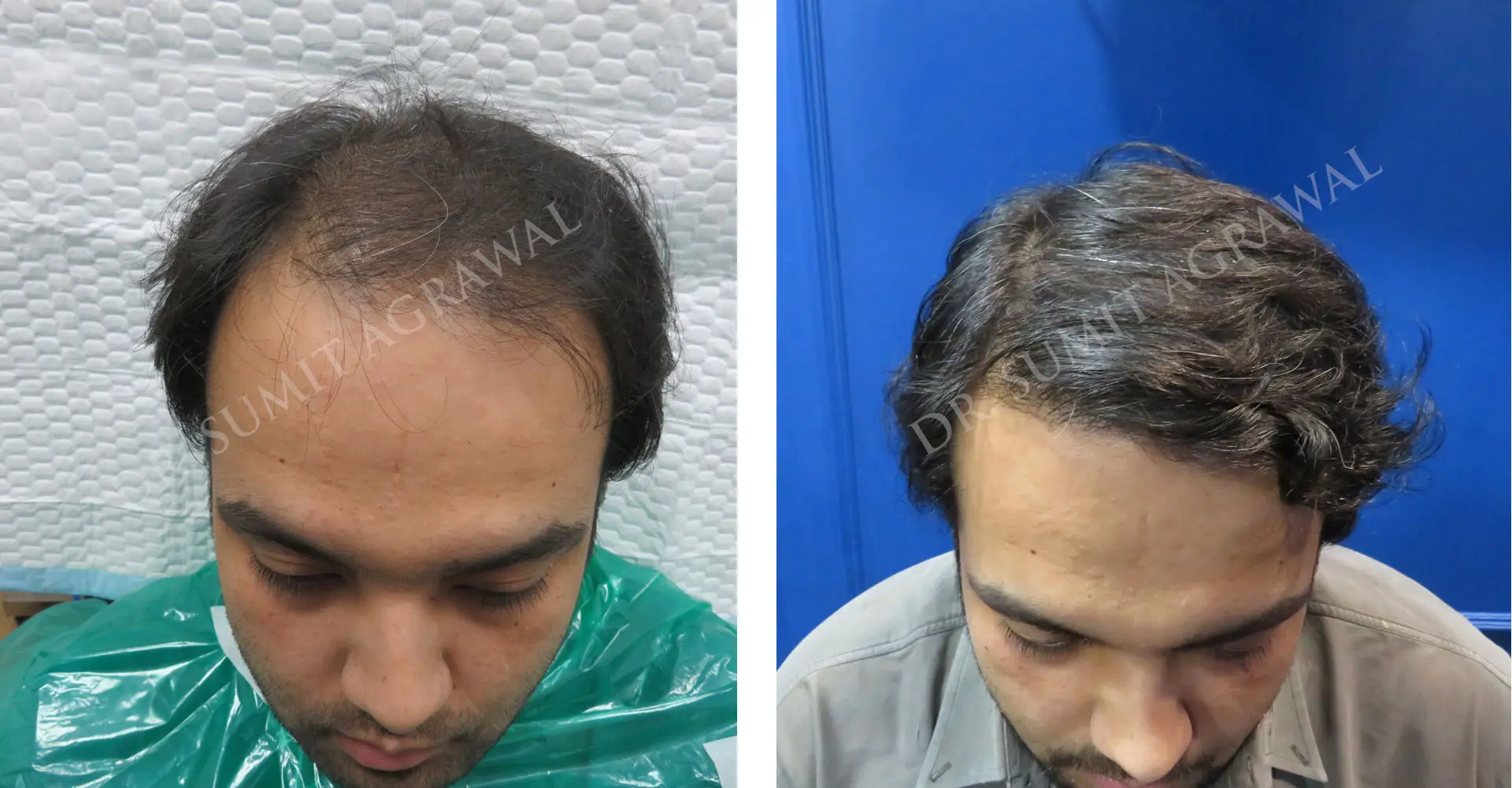 View Fue Hair Transplant Before and After photos of successful results by Dr. Sumit Agrawal