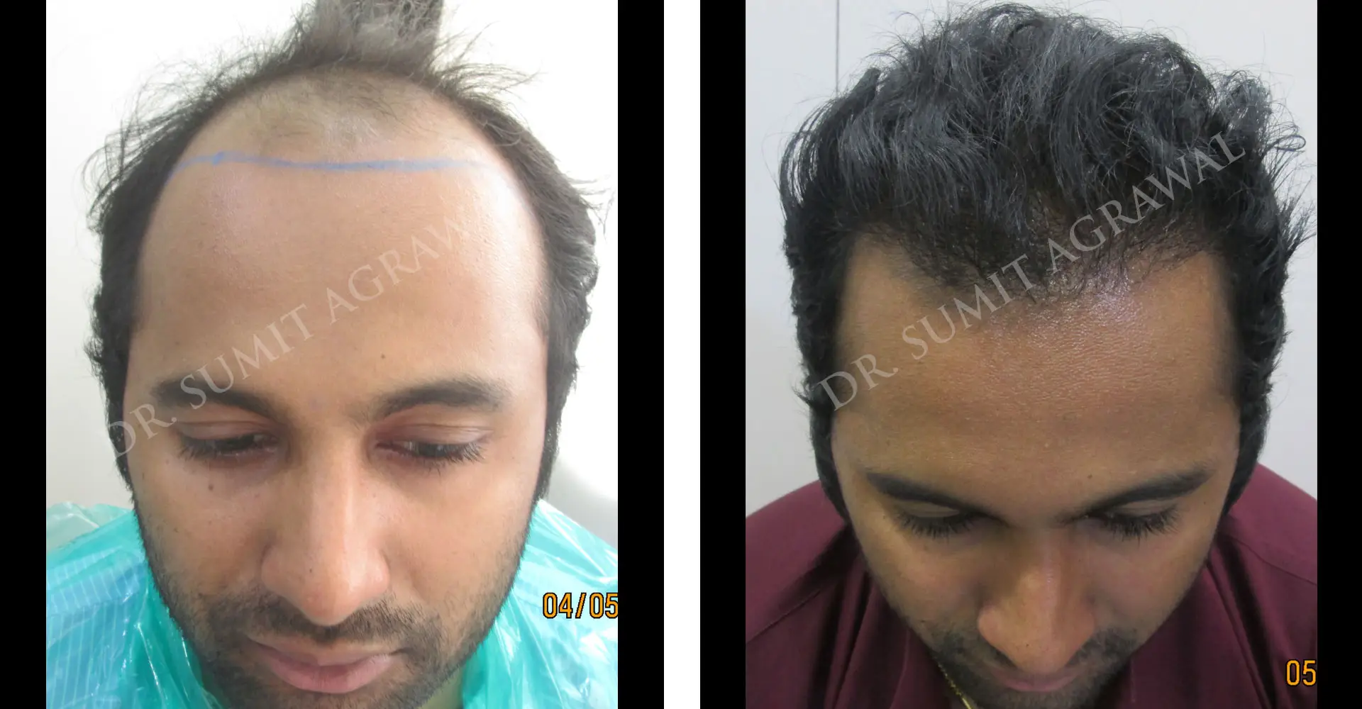View Fut Hair Transplant Before and After photos of successful results by Dr. Sumit Agrawal.