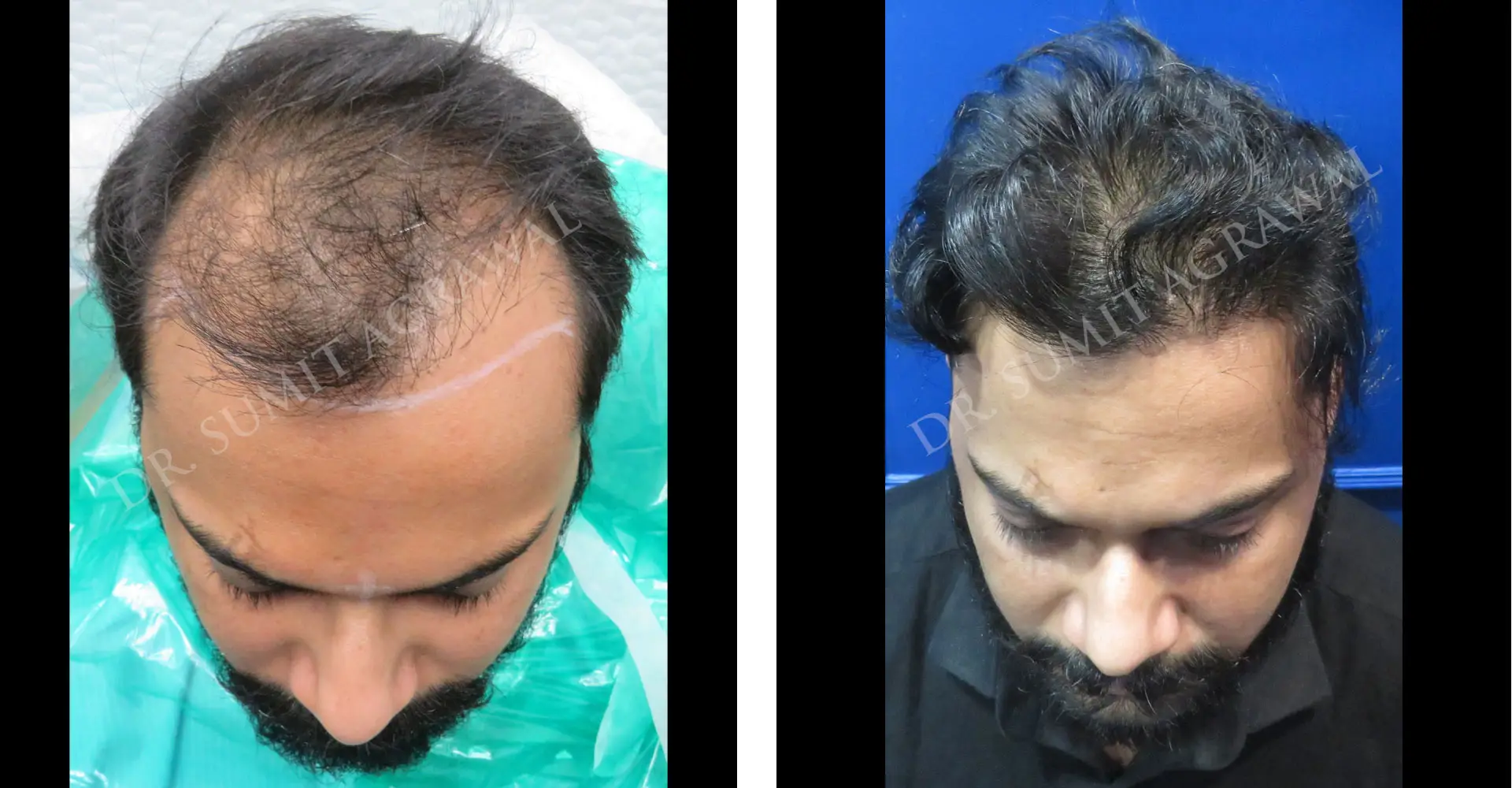 View Revision Hair Transplant Before and After photos of successful results by Dr. Sumit Agrawal.