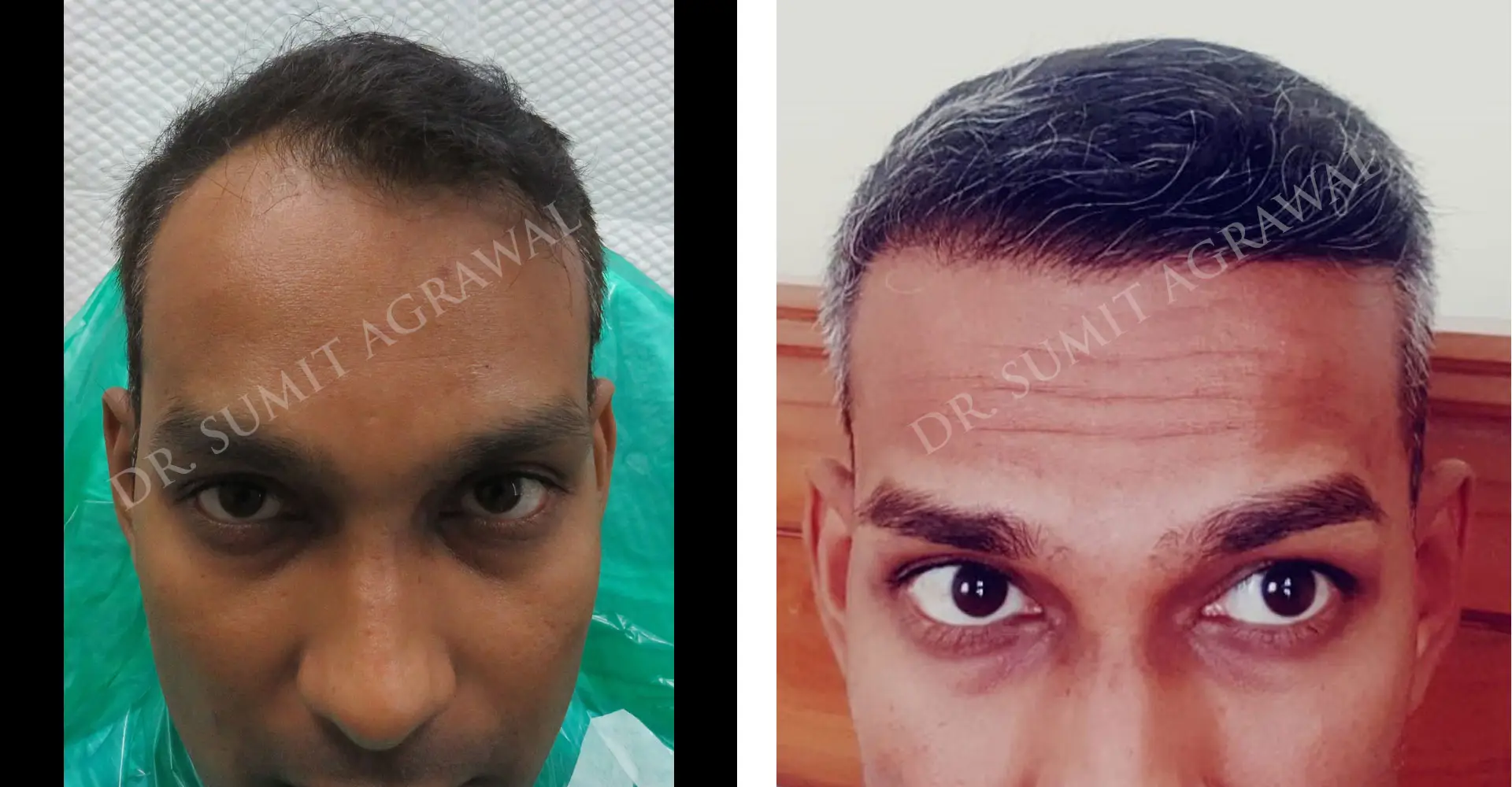 FueHair Transplant Before and After photos of successful results by Dr. Sumit Agrawal. 