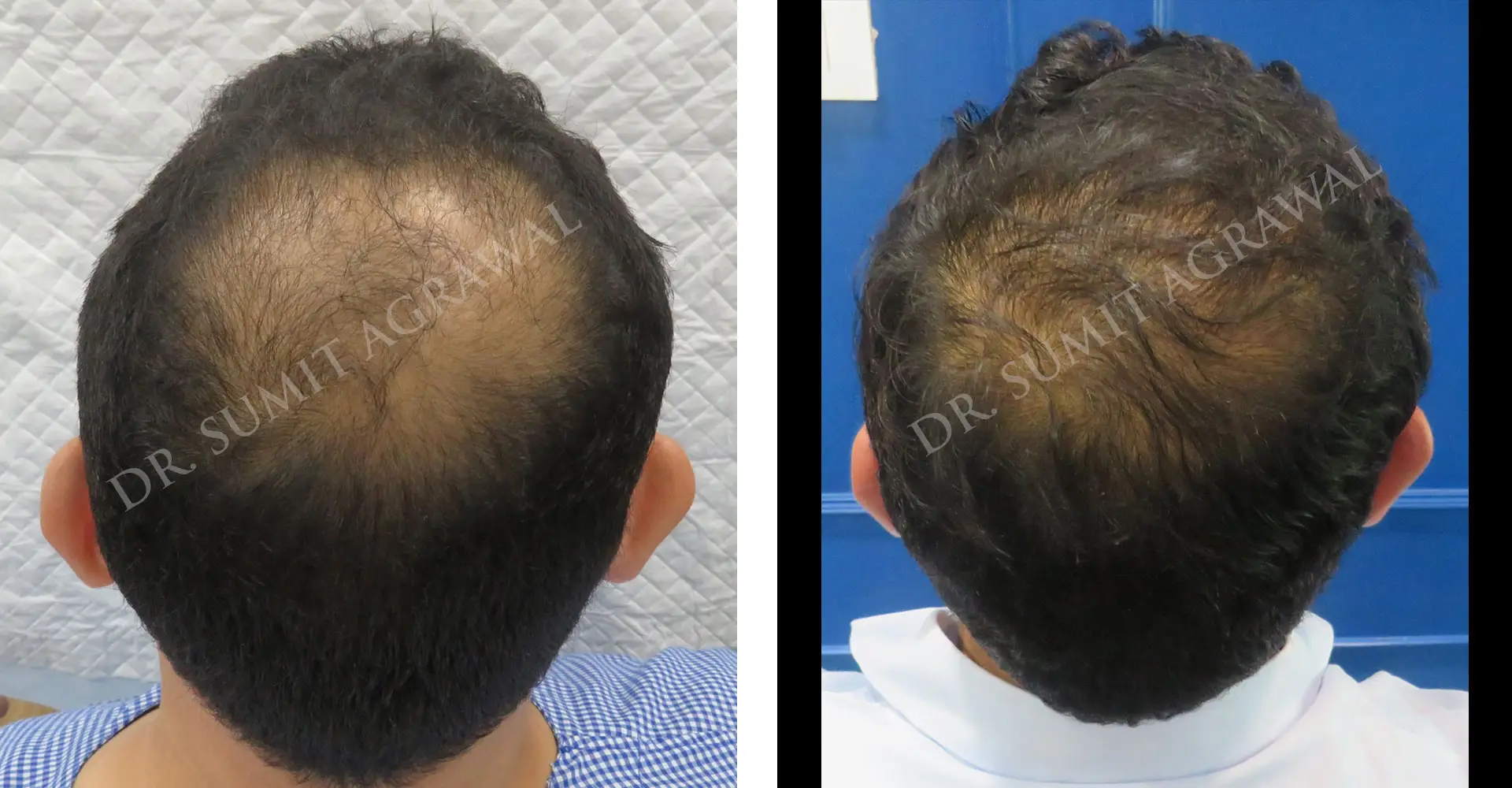 View Vertex (crown) Hair Transplant Before and After photos of successful results by Dr. Sumit Agrawal.