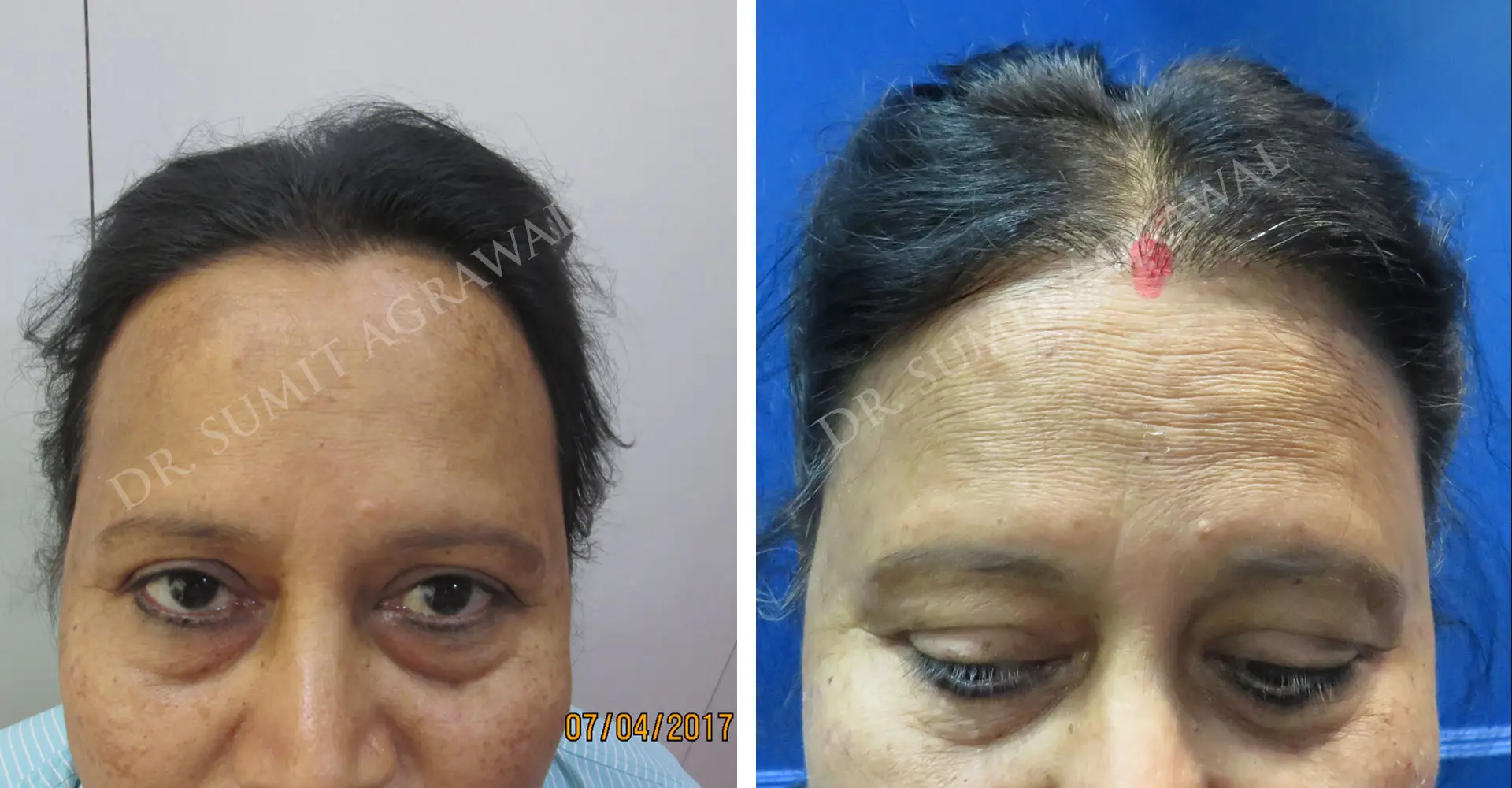 Female Hair Transplant Before and After photos of successful results by Dr. Sumit Agrawal.