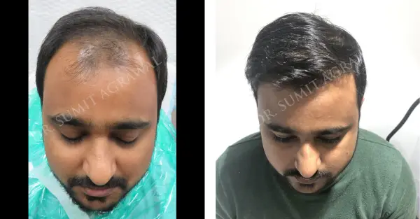 Before and After Hair Transplant Results