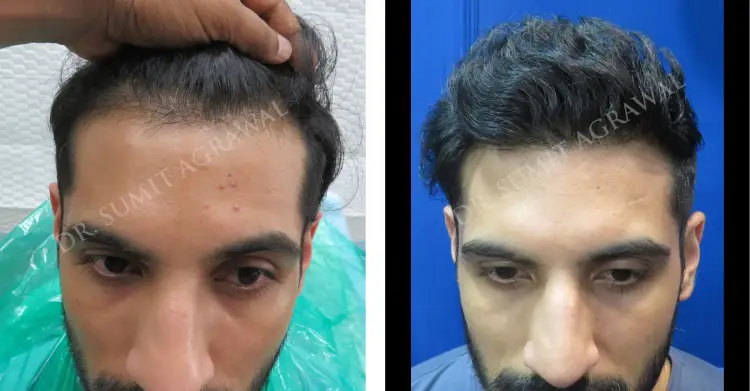 Before and After India Hair Transplant