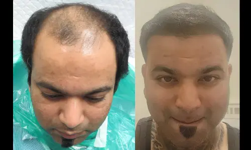 Case Study Hair Transplant