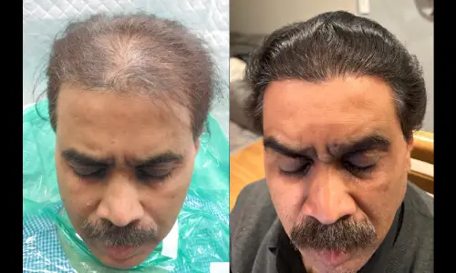 Case Study Hair Transplant