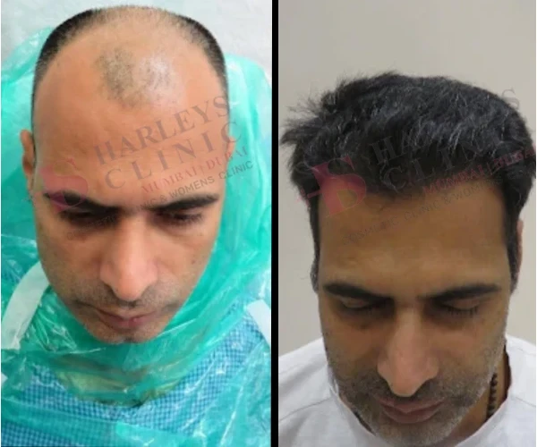 Hair Transplant Before and After 1